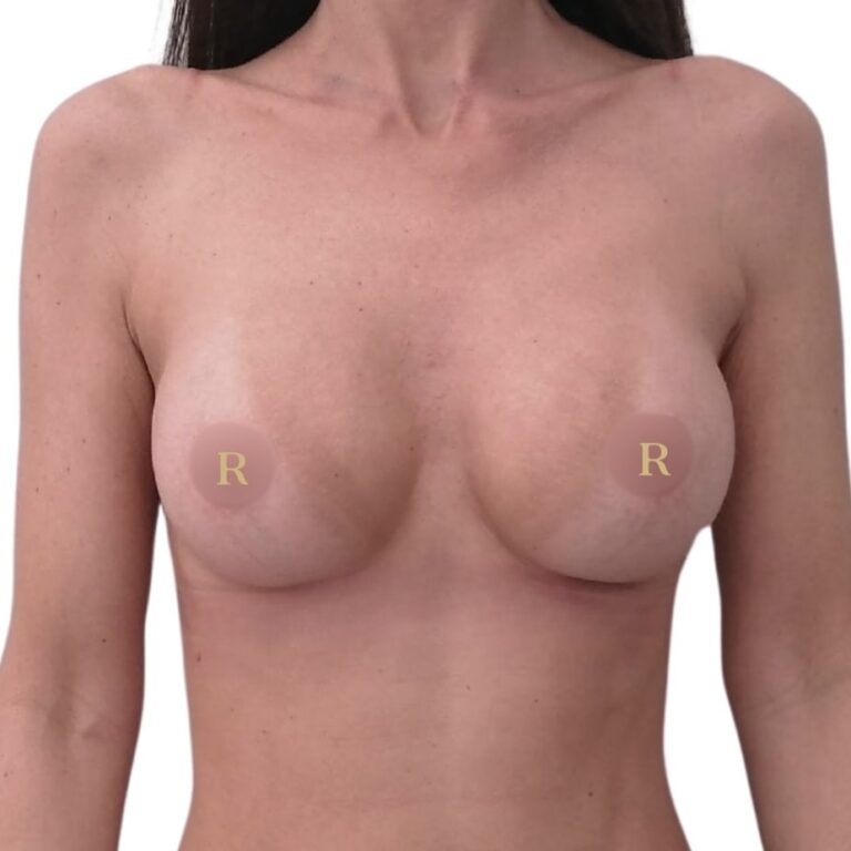 Breast augmentation with implants after treatment