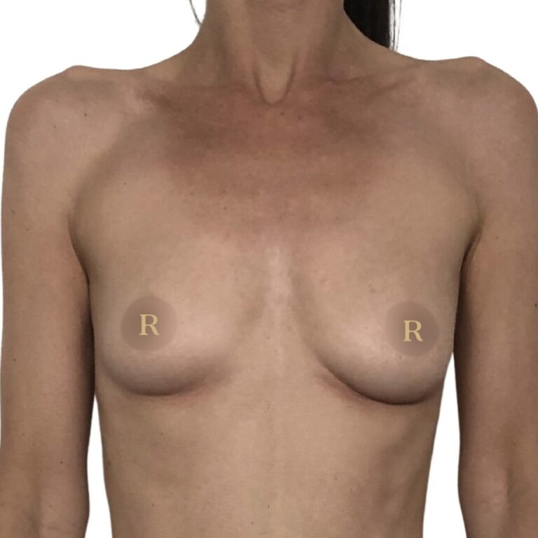 Breast augmentation with implants before treatment