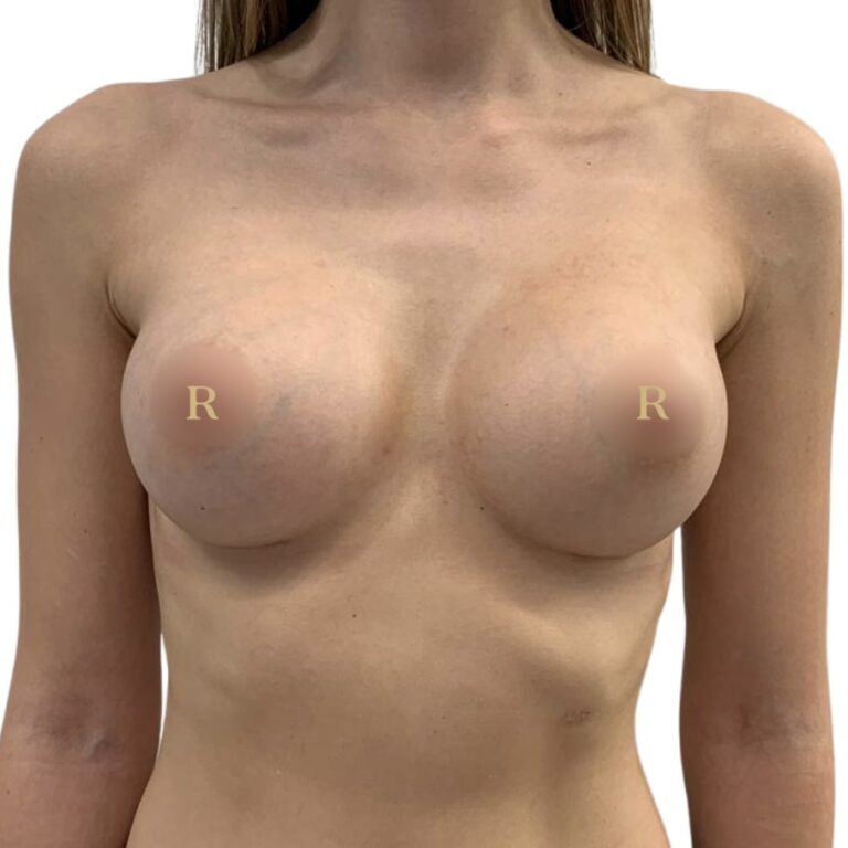 Breast augmentation with implants after treatment