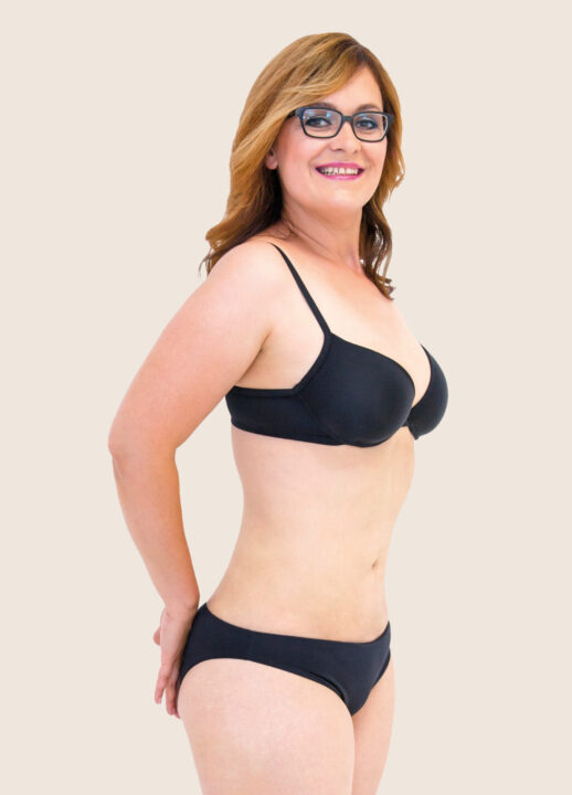 Liposuction of the abdomen and flanks after treatment