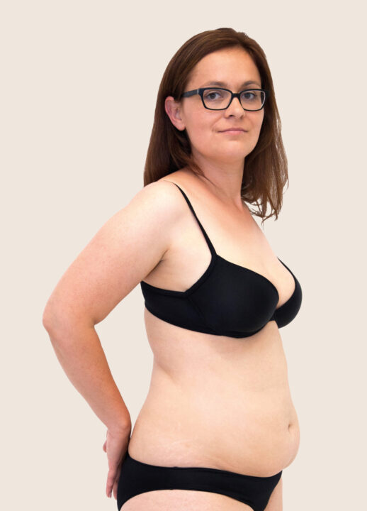 Liposuction of the abdomen and flanks before treatment